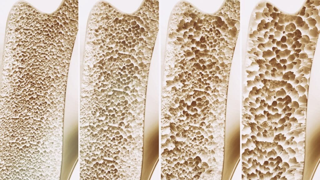 4 skirtingos osteoporozės stadijos